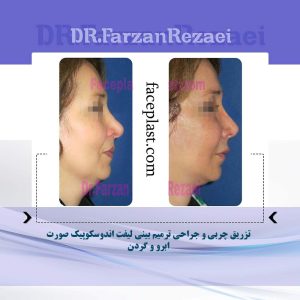 ﺗﺰﺭﻳﻖ ﭼﺮﺑﻲ ﻭ ﺟﺮﺍﺣﻲ ﺗﺮﻣﻴﻢ ﺑﻴﻨﻲ ﻟﻴﻔﺖ ﺍﻧﺪﻭﺳﻜﻮﭘﻴﻚ ﺻﻮﺭﺕ ﺍﺑﺮﻭ ﻭ ﮔﺮﺩﻥ
