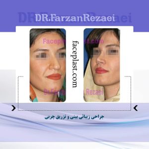 جراحی زیبائی بینی و تزریق چربی