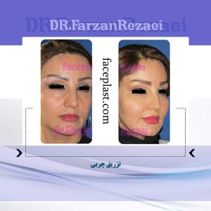 تزریق چربی