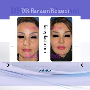 تزریق چربی