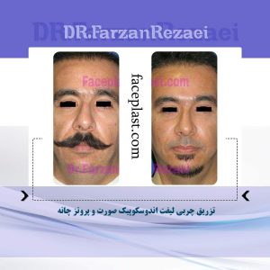 تزریق چربی لیفت اندوسکوپیک صورت و پروتز چانه