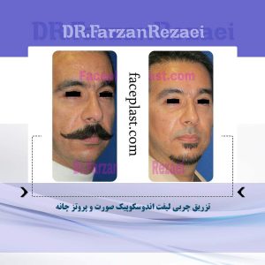 تزریق چربی لیفت اندوسکوپیک صورت و پروتز چانه