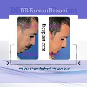 تزریق چربی لیفت اندوسکوپیک صورت و پروتز چانه