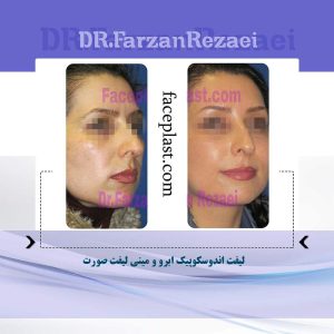 ﻟﻴﻔﺖ ﺍﻧﺪﻭﺳﻜﻮﭘﻴﻚ ابرو و ميني ليفت صورت