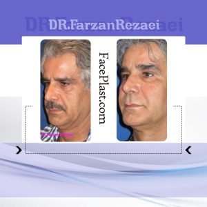جراحى پلك پايين، جوان سازى صورت با تزريق چربى