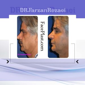 جراحى پلك پايين، جوان سازى صورت با تزريق چربى