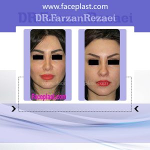 جراحی زیبایی بینی 