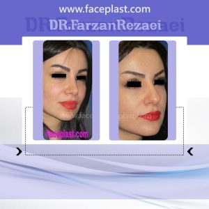 جراحی زیبایی بینی 