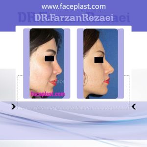 جراحی زیبایی بینی 