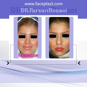 جراحی زیبایی بینی