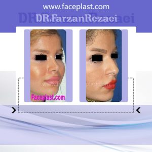 جراحی زیبایی بینی