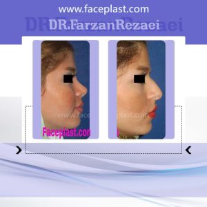جراحی زیبایی بینی