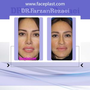 جراحی زیبایی بینی