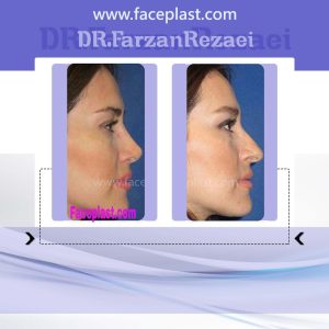 جراحی زیبایی بینی