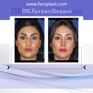 جراحی زیبایی بینی