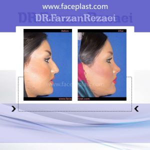 جراحی زیبایی بینی