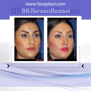 جراحی زیبایی بینی