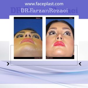 جراحی زیبایی بینی