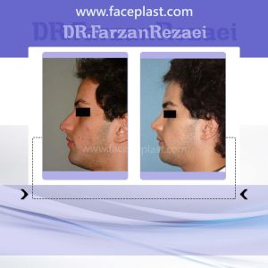 عمل زیبایی بینی