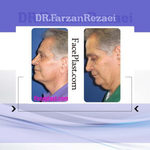 ليفت صورت و گردن و ساكشن گردن (2)