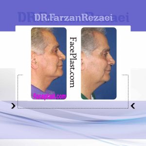 ليفت صورت و گردن و ساكشن گردن (4)