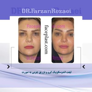 لیفت اندوسکوپیک ابرو و تزریق چربی به صورت