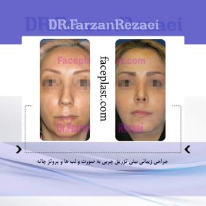ﺟﺮﺍﺣﻲ ﺯﻳﺒﺎﺋﻲ ﺑﻴﻨﻲ ﺗﺰﺭﻳﻖ ﭼﺮﺑﻲ ﺑﻪ ﺻﻮﺭﺕ ﻭ ﻟﺐ ﻫﺎ ﻭ ﭘﺮﻭﺗﺰ ﭼﺎﻧﻪ