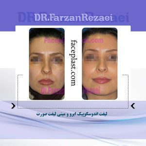 ﻟﻴﻔﺖ ﺍﻧﺪﻭﺳﻜﻮﭘﻴﻚ ابرو و ميني ليفت صورت