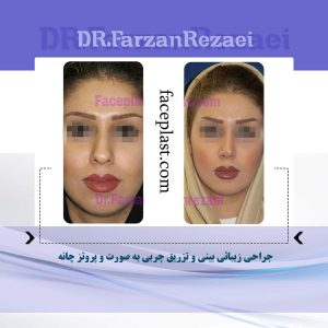 ﺟﺮﺍﺣﻲ ﺯﻳﺒﺎﺋﻲ ﺑﻴﻨﻲ ﻭ ﺗﺰﺭﻳﻖ ﭼﺮﺑﻲ ﺑﻪ ﺻﻮﺭﺕ ﻭ ﭘﺮﻭﺗﺰ ﭼﺎﻧﻪ