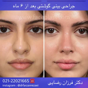 جراحی زیبایی بینی 024