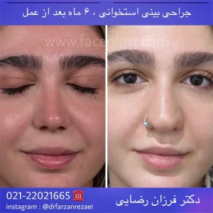 جراحی زیبایی بینی 016