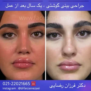 جراحی زیبایی بینی 019
