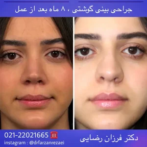 جراحی زیبایی بینی 020