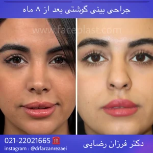 جراحی زیبایی بینی 022