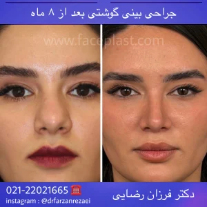 جراحی زیبایی بینی 023