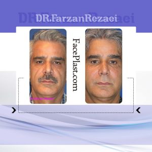 جراحى پلك پايين، جوان سازى صورت با تزريق چربى