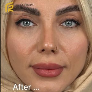 جراحی پرزرویشن - دکتر فرزان رضایی -/faceplast.com