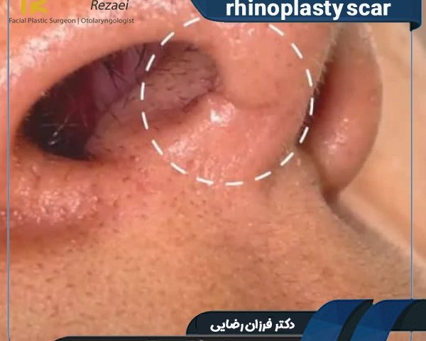 rhinoplasty scar
