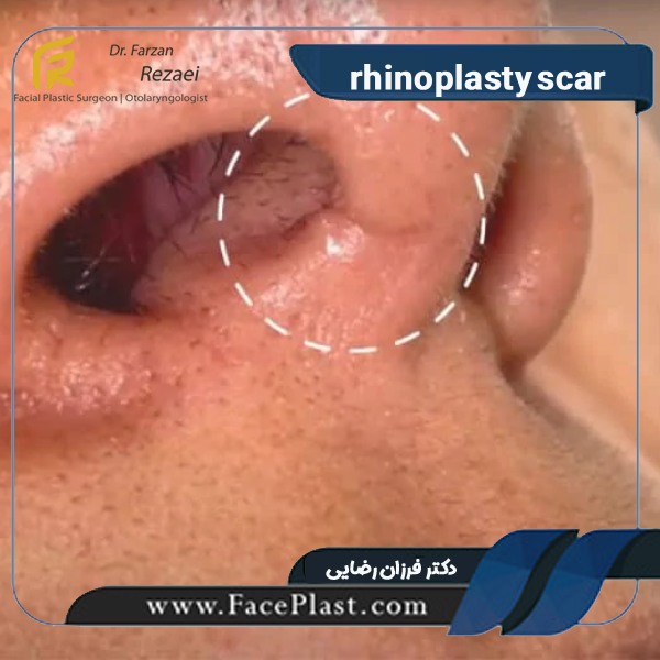 rhinoplasty scar