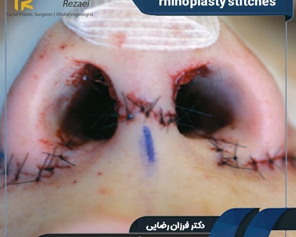 rhinoplasty stitches