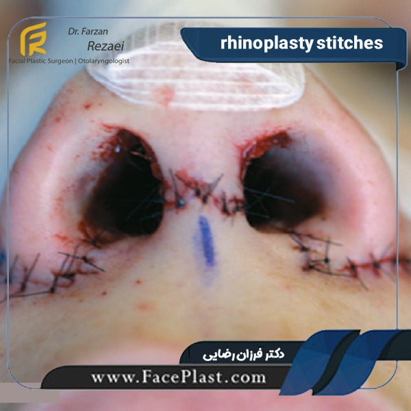 rhinoplasty stitches