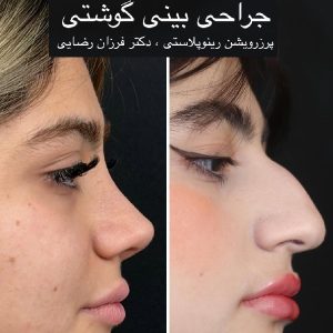 عکس قبل و بعد عمل بینی گوشتی