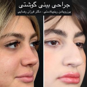 عکس قبل و بعد عمل بینی گوشتی