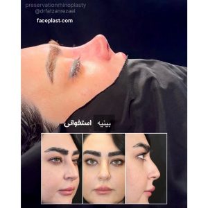 عکس قبل و بعد عمل بینی استخوانی 1