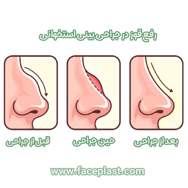 رفع قوز در جراحی بینی استخوانی