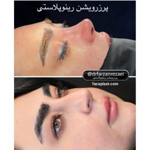 عکس قبل و بعد عمل بینی استخوانی 2