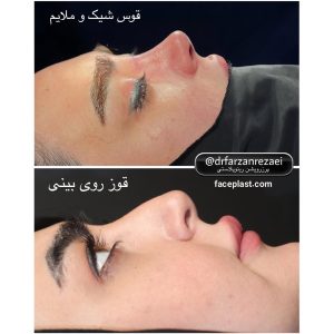 عکس قبل و بعد عمل بینی استخوانی 3