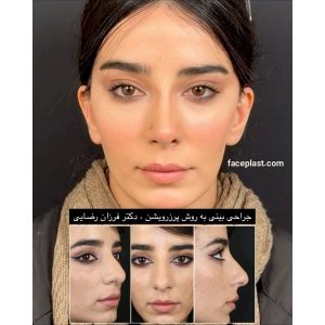 عکس عمل بینی استخوانی نیمه فانتزی 1
