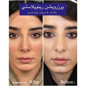 عکس عمل بینی استخوانی نیمه فانتزی 2