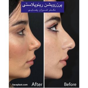 عکس عمل بینی استخوانی نیمه فانتزی 3